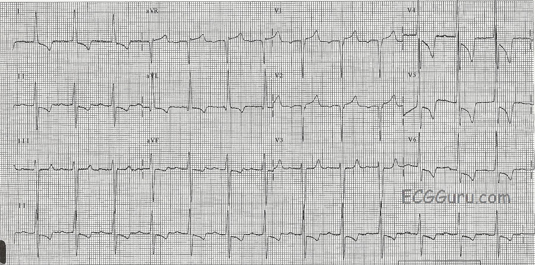 left-ventricular-hypertrophy-with-strain-ecg-guru-instructor-resources